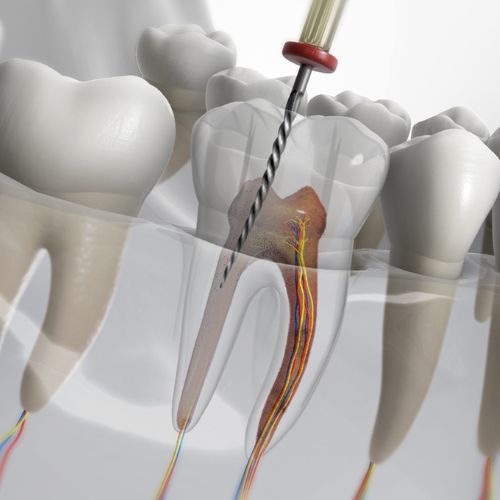 Root Canal Treatment Dombivli