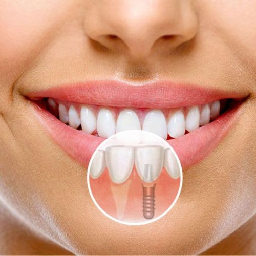 Dental Implant Treatment in Dombivli