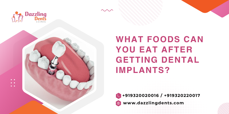 What Foods Can You Eat After Getting Dental Implants?